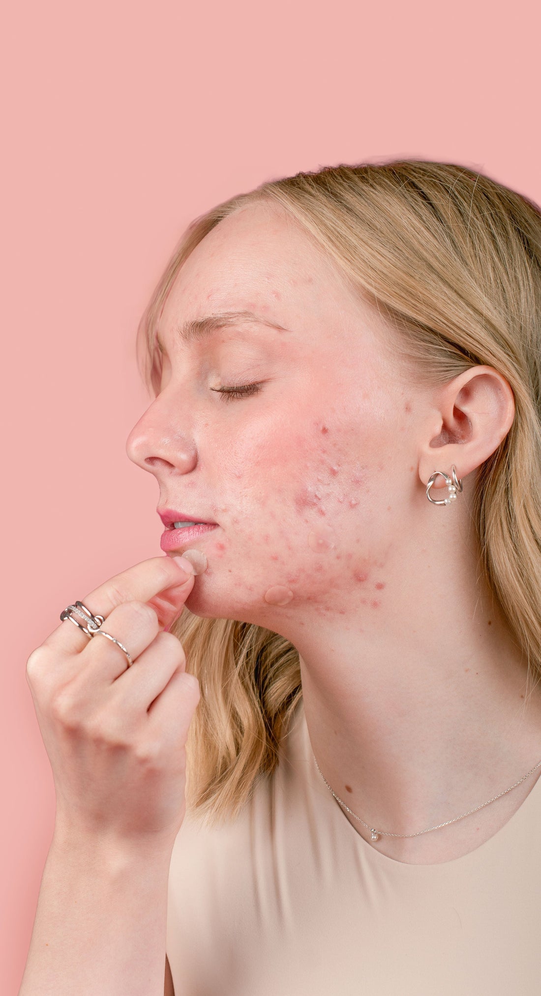 Why Your Pimple Patch Keeps Falling Off (and How to Fix It)
